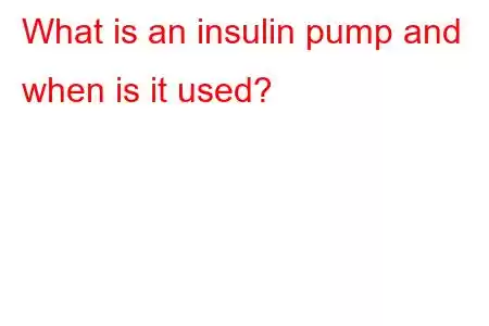 インスリンポンプとは何ですか?いつ使用されますか?